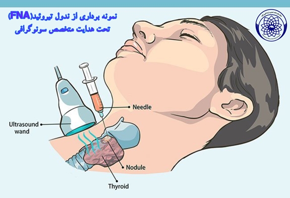  ارائه خدمت جدید سونوگرافی تخصصی و نمونه‌برداری (FNA) در بیمارستان امام خمینی (ره) فیروزکوه  بیمارستان امام خمینی (ره) فیروزکوه از آغاز به کار واحد تخصصی سونوگرافی و انجام نمونه‌برداری‌های ظریف تحت هدایت سونوگرافی (FNA) توسط متخصص رادیولوژی خبر داد.  به گزارش روابط عمومی بیمارستان؛ در راستای ارتقای خدمات تشخیصی و درمانی و کاهش مراجعات بیماران به پایتخت، واحد تصویربرداری این مرکز در روزهای چهارشنبه و پنجشنبه هر هفته، خدمات ویژه‌ای را در حوزه تشخیص توده‌ها و ندول‌های بدن ارائه می‌دهد.  ### تشخیص دقیق؛ گام نخس